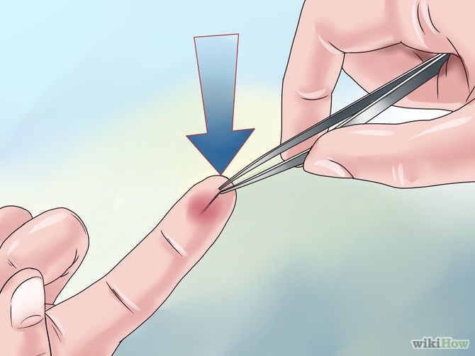 Healthcare Times - How to Remove a Splinter